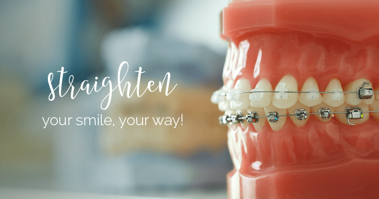 Close-up of braces that can straighten your smile your way
