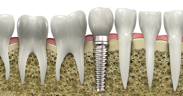 Closeup of a dental implant